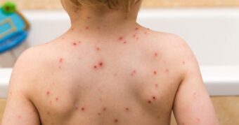 Epidemija morbila u Kantonu Sarajevo! Upućen apel roditeljima: Vakcinišite svoje dijete