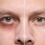 Zbogom, podočnjaci: 5 prirodnih pomagača iz smočnice/Photo: Shutterstock