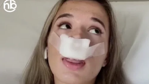 Tiktokerka operisala nos da bi njena buduća djeca bila ROĐENA SA LIJEPIM NOSEM! 